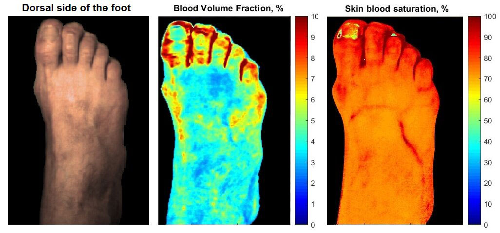 HYPERSPECTRAL IMAGING USED TO REVEAL DIABETIC SKIN COMPLICATIONS