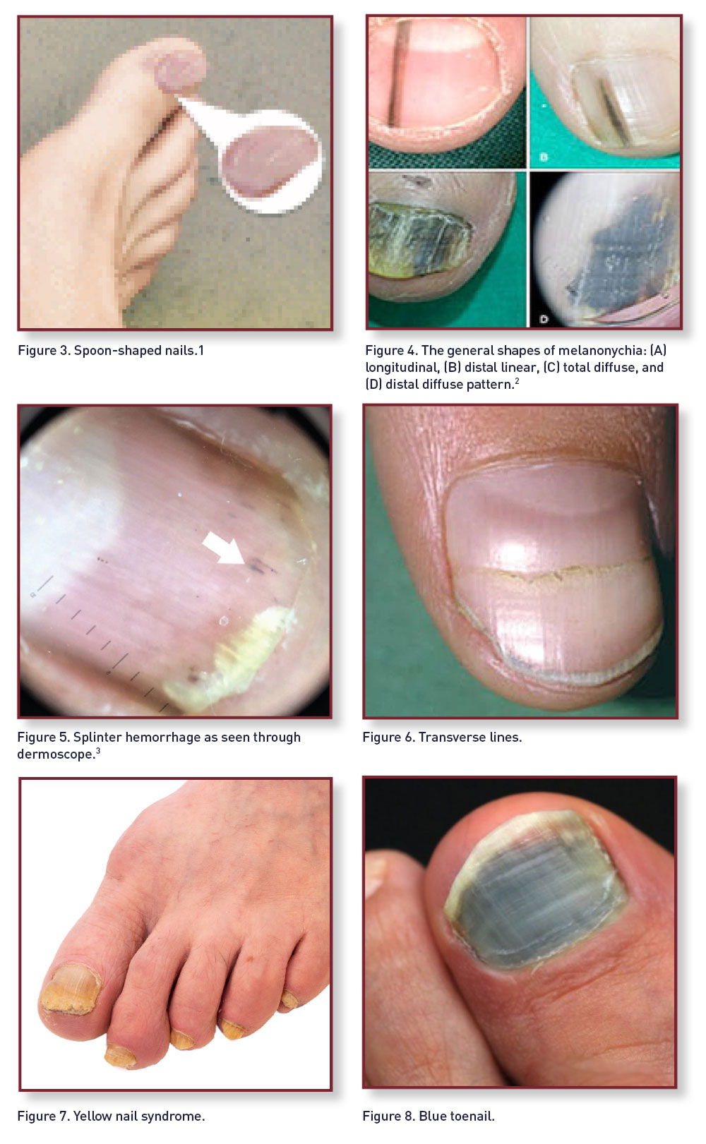 Common Skin and Nail Conditions of the Lower Extremity: Part 3 | Lower  Extremity Review Magazine
