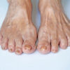 Common Skin and Nail Conditions of the Lower Extremity: Part 3