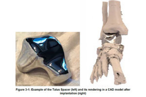 Patient Specific Talus Spacer