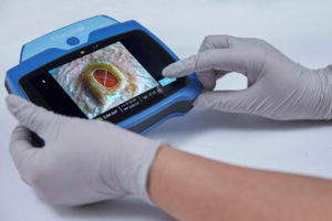 MOLECULIGHTDX ENABLES POINT-OF-CARE IMAGING OF WOUNDS