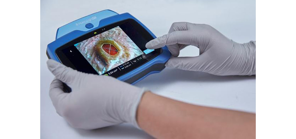 MOLECULIGHTDX ENABLES POINT-OF-CARE IMAGING OF WOUNDS