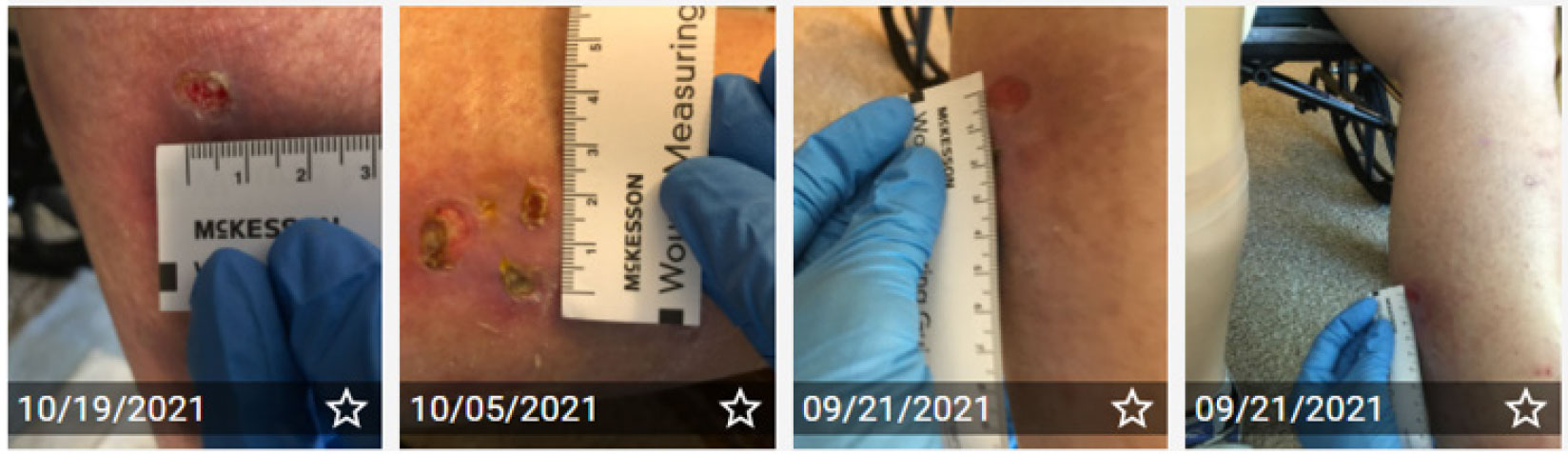 The Importance of Obtaining Wound Photographs