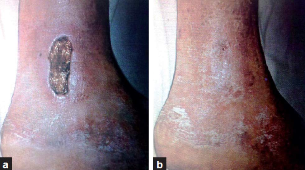 The Role of Collagen Dressings in Wound Management