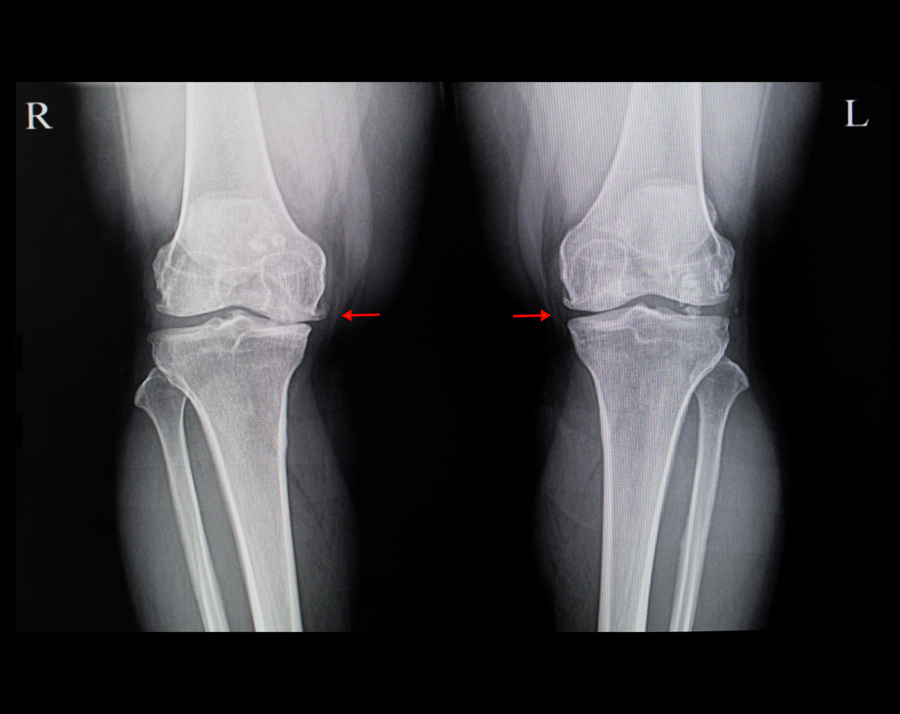 AAOS Highlights New AJRR Data