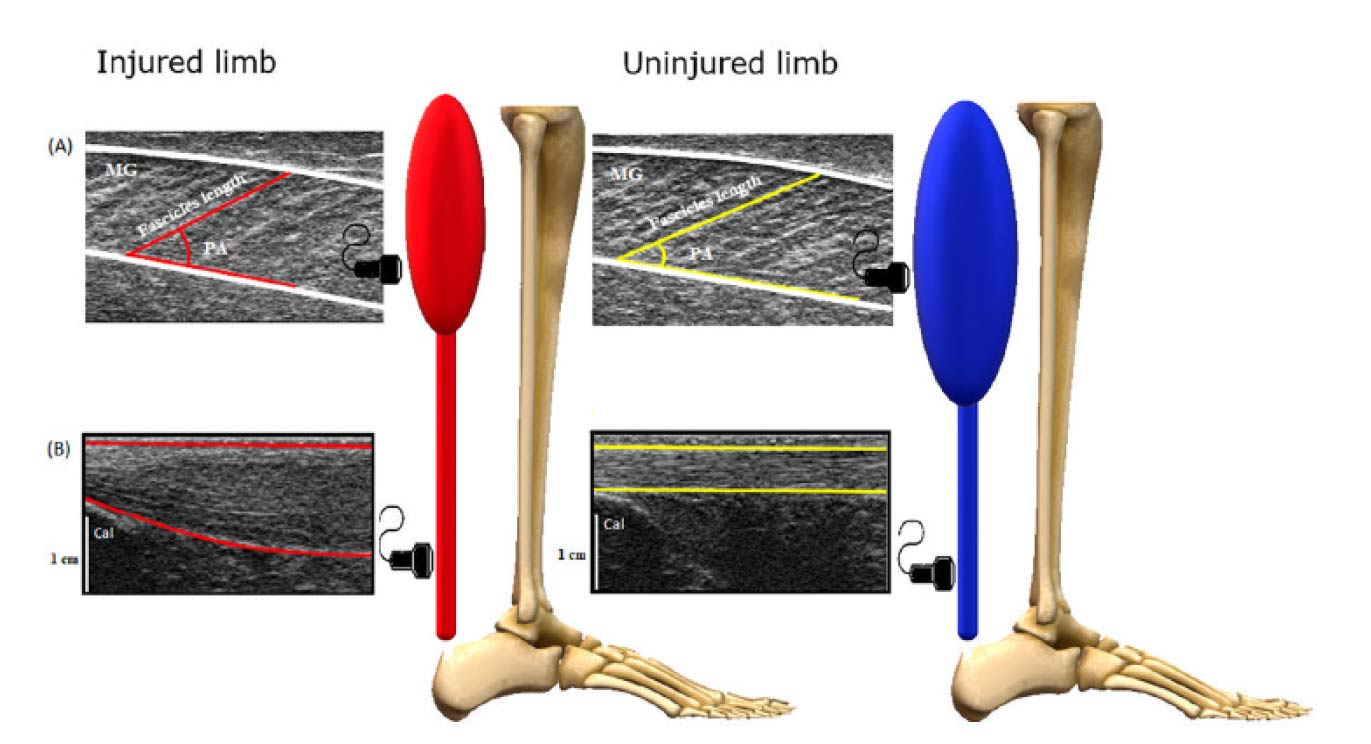 LONGER FASCICLE LENGTH MAY CAUSE DEFICIT IN NON-SURGICAL HEALING OF ACHILLES