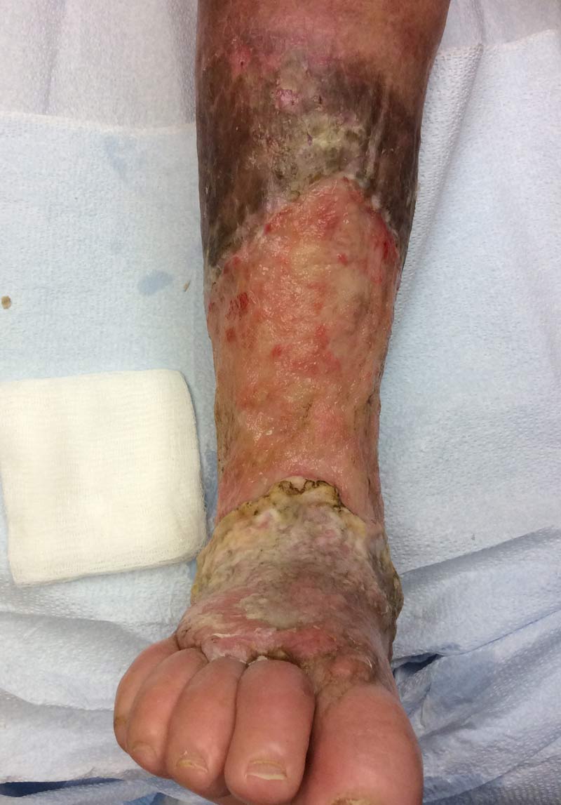 Lymphatic Immunopathy and Its Importance in Chronic Wound Healing