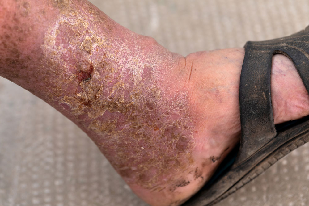 Inflammatory Markers in Diabetic Foot Infections