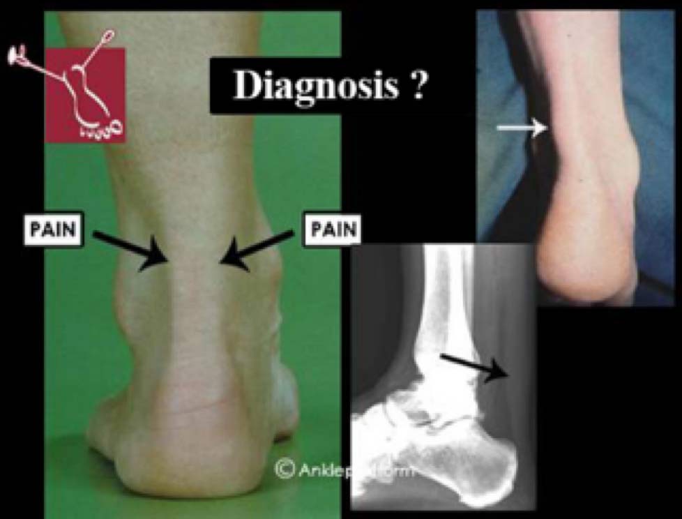 Increasing Consensus on Terminology of Achilles Tendon–Related Disorders