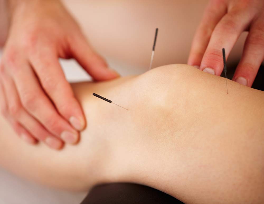ACUPUNCTURE APPEARS TO REDUCE FRACTURE RISK IN OA