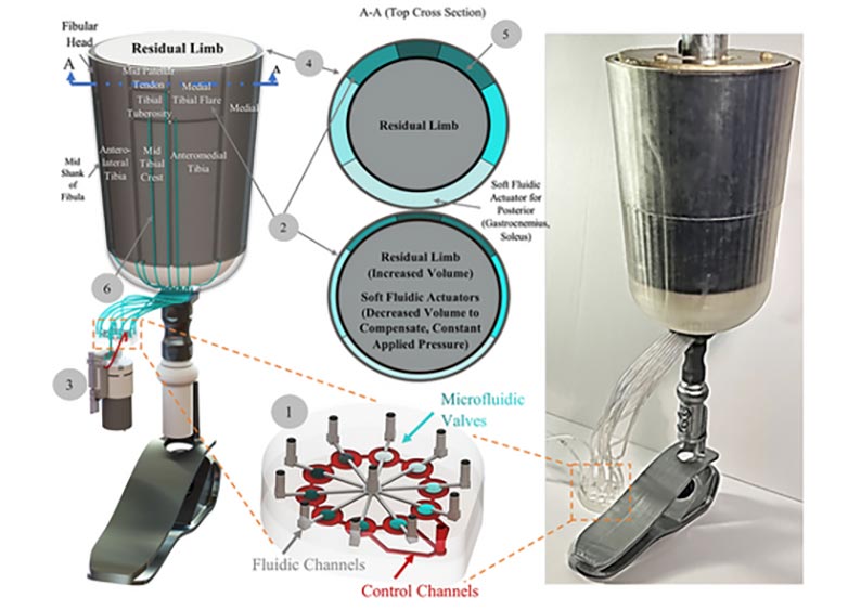 Microfluidic-Based Robotic Prosthesis Lowers Socket Pressure