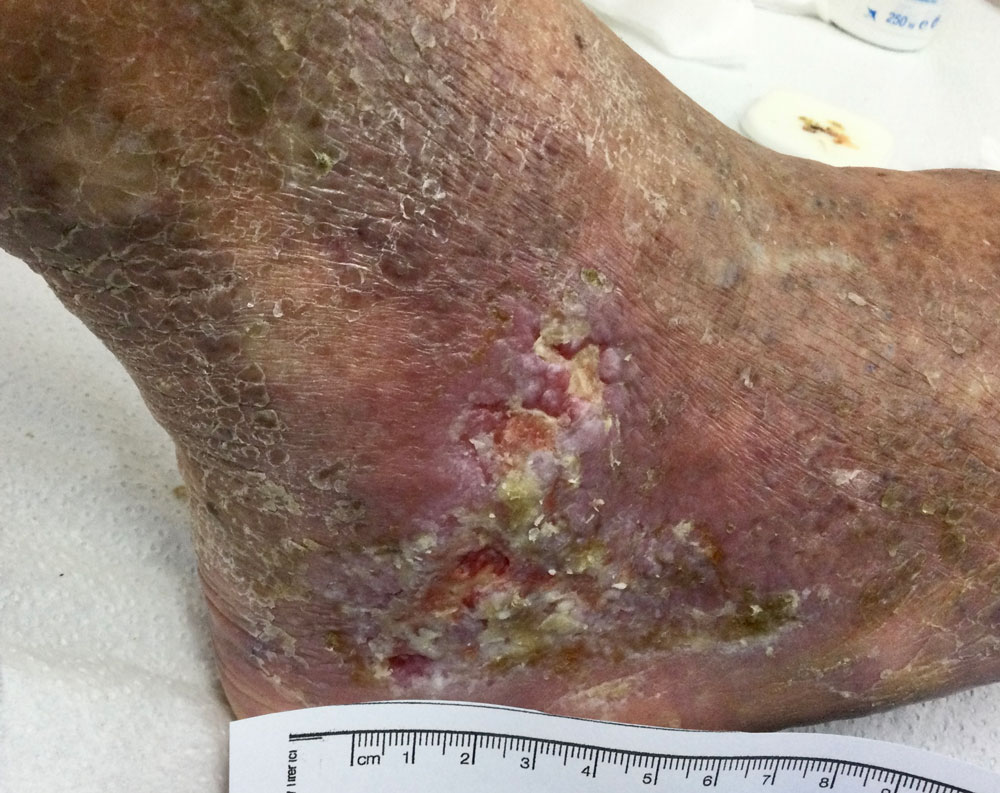 Chronic Venous Insufficiency and the Diabetic Patient: Is There a Connection?
