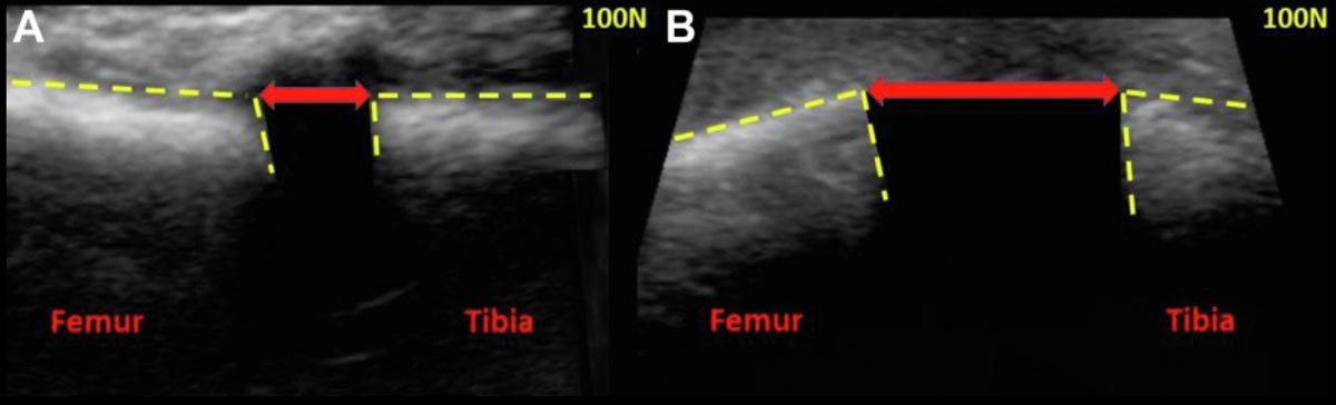 Dynamic Ultrasound Accurately Quantifies Severity of Medial Knee Injury