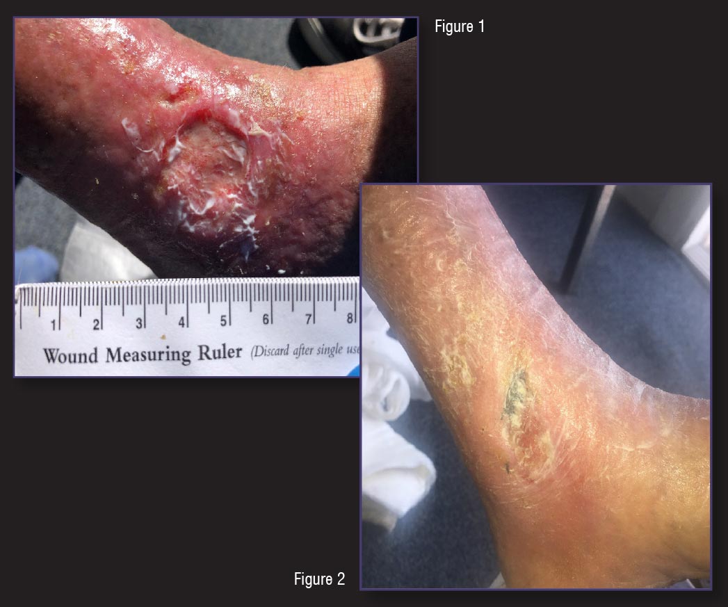 leg ulcers treatment