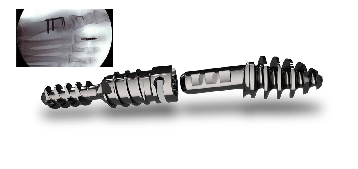 Hammertoe Treatment Technology