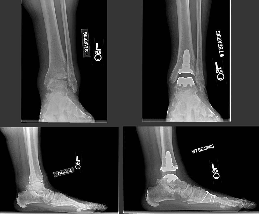 By the Numbers: Total Ankle Arthroplasty Trends ↗