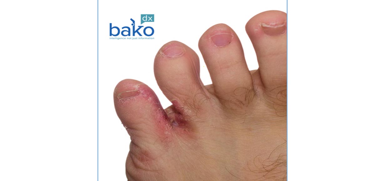 PCR Test for Detection of Interdigital Infections 