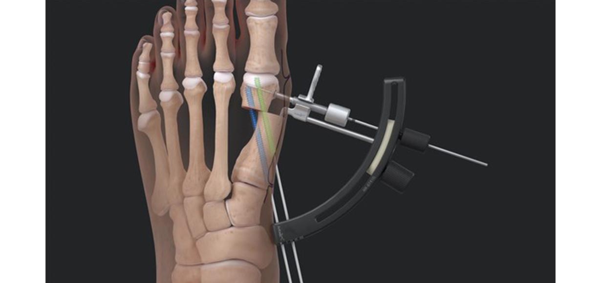 Minimally Invasive Bunionectomy System