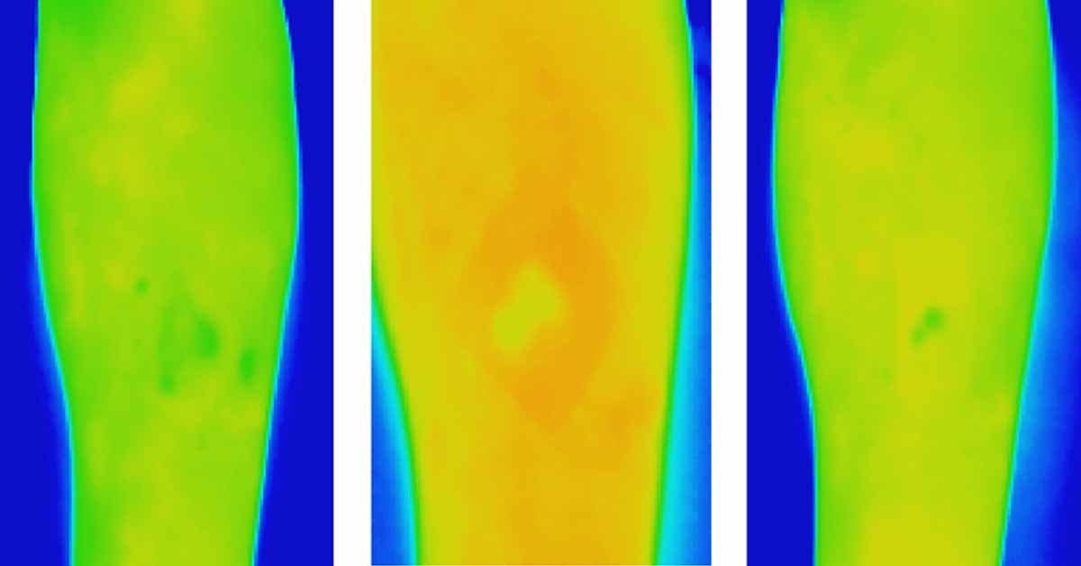 Contactless Screening Tool for Chronic Wound Treatment