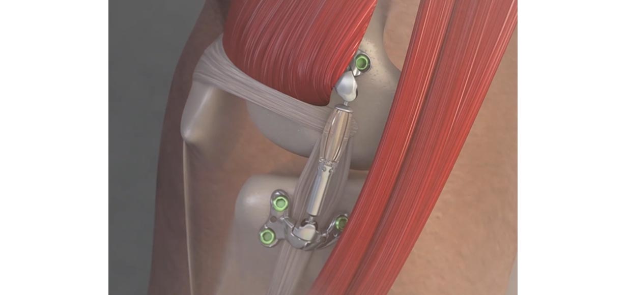 Implantable Knee Shock Absorber