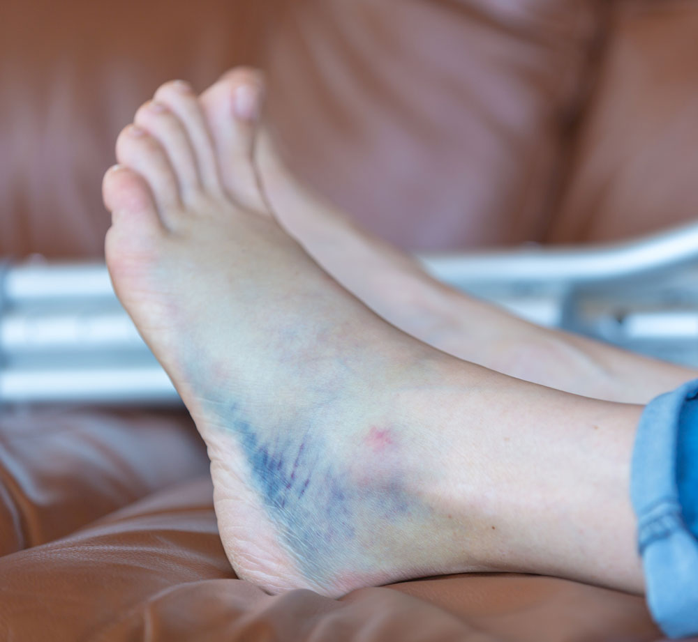 When an Ankle Injury Isn’t Just a Sprain