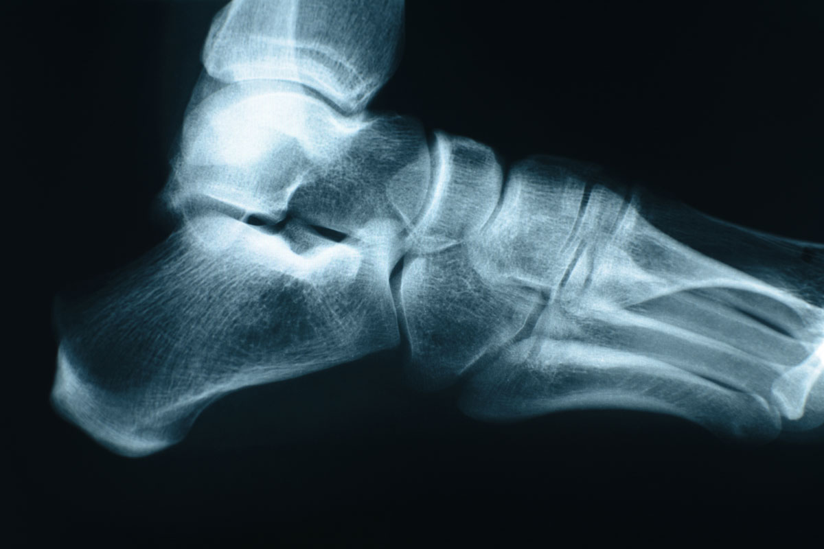 Bone Stress Injuries at the Ankle and Foot