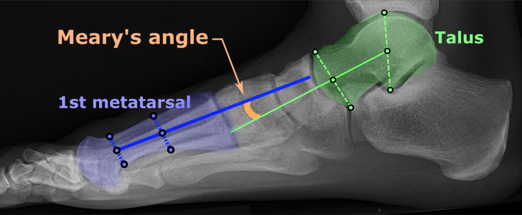 Pediatric Arch Pain Linked to Talus-1/-2 Metatarsal Angles