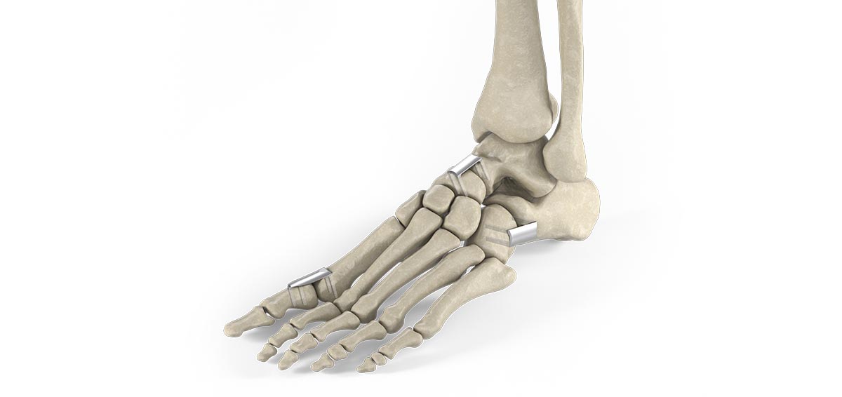 Foot Drop: A Primer  Lower Extremity Review Magazine