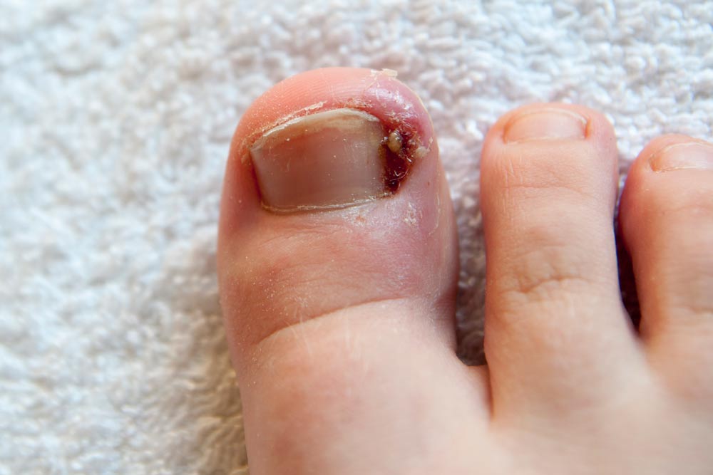 Surgical Treatment of Ingrown Toenails Part 1: Recurrence and Relief