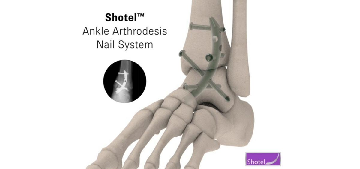 Ankle Arthrodesis Nail System