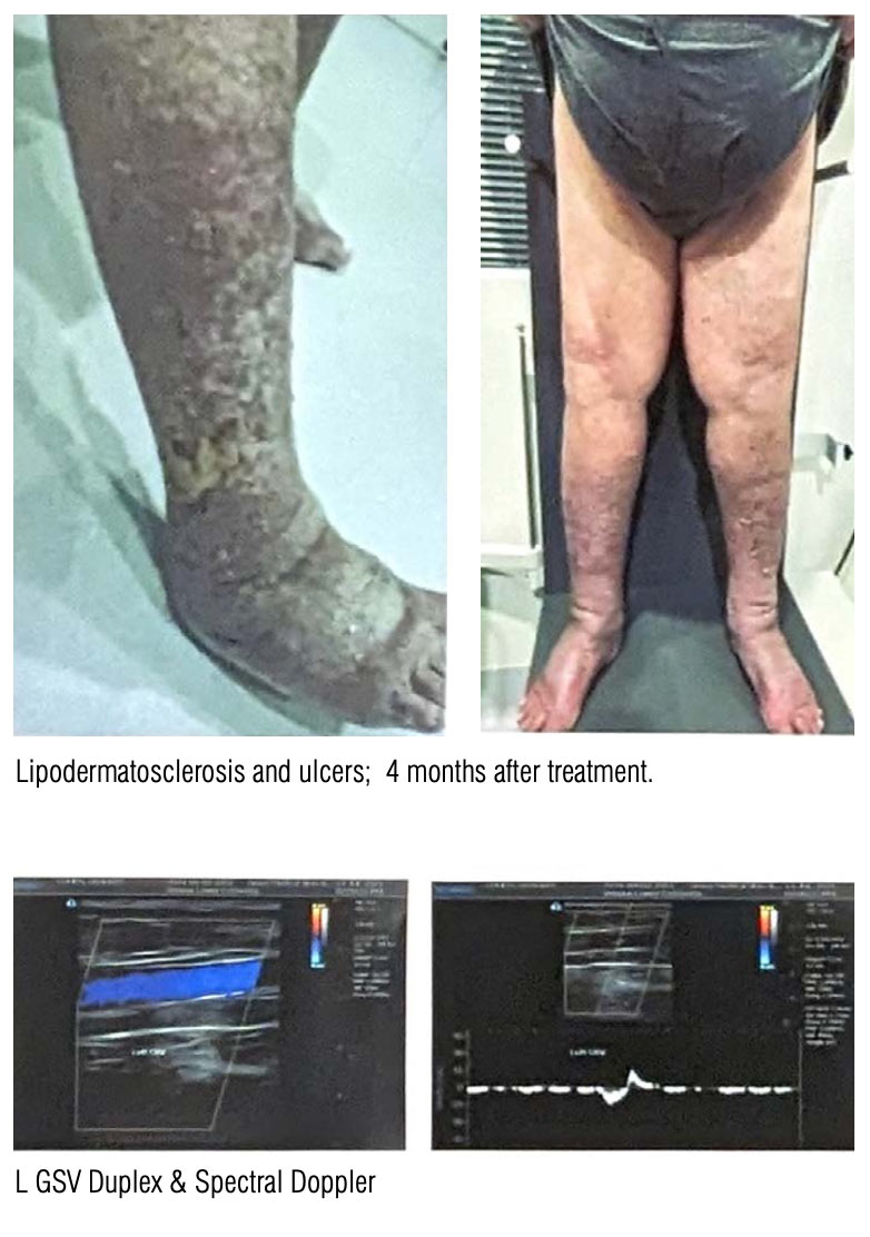 Chronic Lipodermatosclerosis in a Patient with Functional Venous Disease