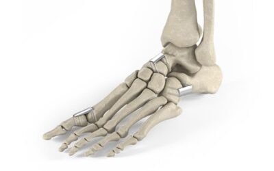 Staples for Midfoot and First MTP Joint Fusions
