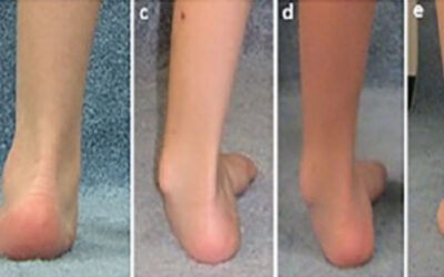 Changes in Foot Posture in Children with CP