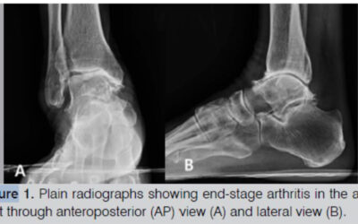 Low Annual Revision Rate in Ankle Distraction for Ankle Osteoarthritis