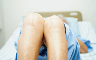 Robotic Assistance in Cementless TKA Does Not Improve 2-Yr Revision Rates