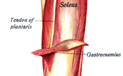 Failing Conservative Achilles Tendon Management? Check Plantaris