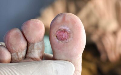 Effectiveness of Offloading Interventions for People With Diabetes-related Foot Ulcers