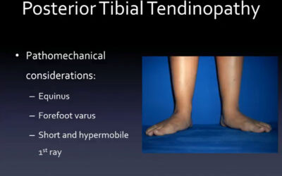lerEXPO Conversations*: Bracing Posterior Tibial Tendon Dysfunction Long Term