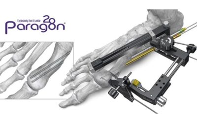 PRECISION® MIS Bunion System
