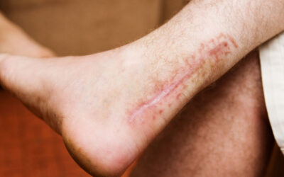 Operative VS Nonoperative Management of Achilles Tendon Ruptures