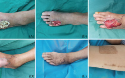 New Wound Surgical Integrated Treatment Uses Antibiotic-Loaded Bone Cement for Non-Weight Bearing DFUs