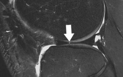 AAOS Updates Clinical Practice Guideline for Management of Acute Isolated Meniscal Pathology