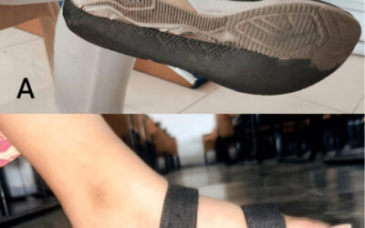 Foot Rehabilitation Exercises for Flatfoot: A Case Study