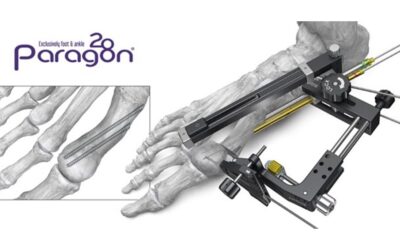 PRECISION® MIS Bunion System