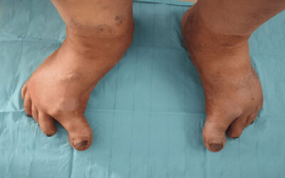 A Case Report: Hypertonia of the Big Toe Revealing Parkinson’s Disease