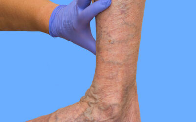 Varicose Veins of the Lower Extremities: A Primer Part II