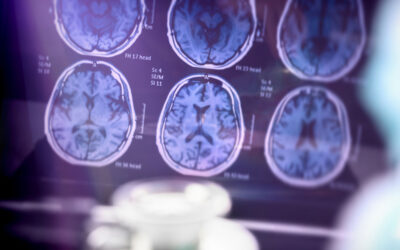 New Study: MS Appears to Protect Against Alzheimer’s