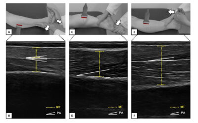 Peri-Ankle Muscles Architecture & Performance Changes in CAI