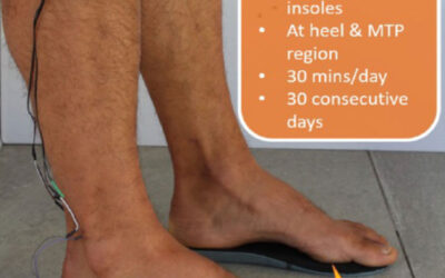 Vibrating Insole Therapy for Sensory Peripheral Neuropathy