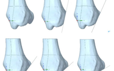 Analysis of Ankle Instability and Posterior Malleolus Fractures